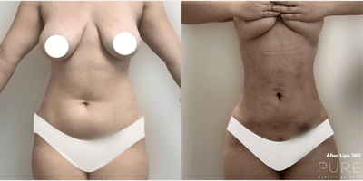 Case 8941 - Woman treated with Liposuction