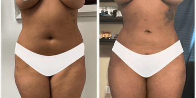 Case 8950 - Woman treated with Liposuction