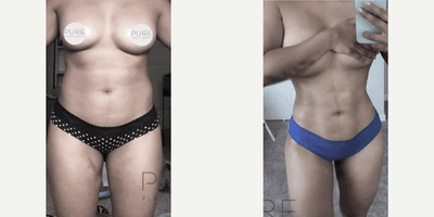 Case 8966 - Woman treated with Liposuction