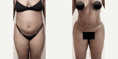 Case 8978 - Woman treated with Liposuction