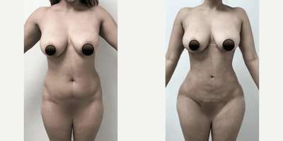 Case 8979 - Woman treated with Liposuction