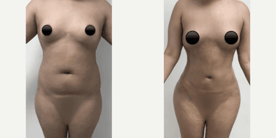 Case 8980 - Woman treated with Liposuction