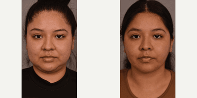 Case 8989 - Woman treated with Chin Liposuction