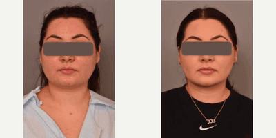 Case 8990 - Woman treated with Chin Liposuction