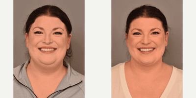Case 8991 - Woman treated with Chin Liposuction