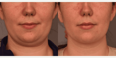 Case 8992 - Woman treated with Chin Liposuction