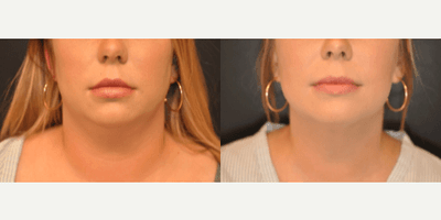 Case 8993 - 25-34 year old woman treated with Chin Liposuction