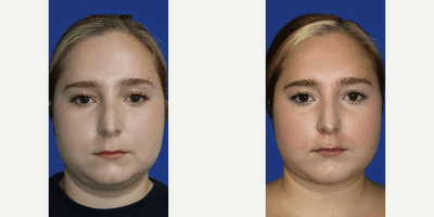 Case 8994 - Woman treated with Chin Implant, Chin Liposuction