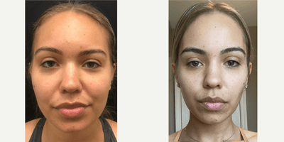 Case 8996 - 25-34 year old woman treated with Chin Liposuction, Buccal Fat Removal