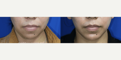 Case 8997 - Woman treated with Neck Lift, Facelift, Chin Liposuction