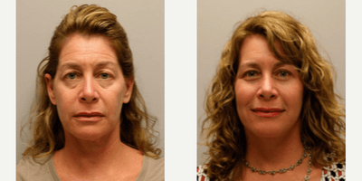 Case 9023 - Woman treated with Chin Liposuction