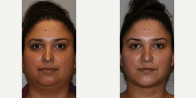 Case 9029 - Woman treated with Chin Liposuction