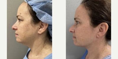 Case 9037 - 35-44 year old woman treated with Chin Liposuction