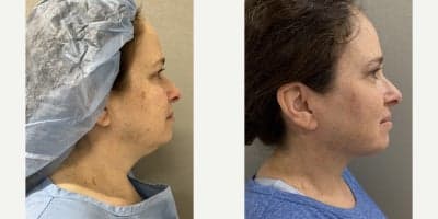 Case 9038 - 35-44 year old woman treated with Chin Liposuction