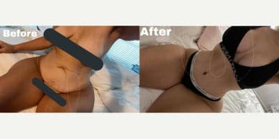 Case 920 - Woman treated with Tummy Tuck