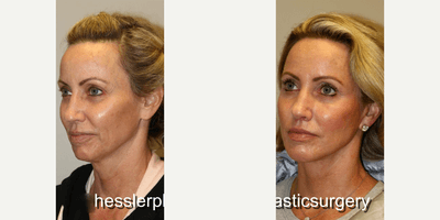 Case 9200 - Woman treated with Chin Implant