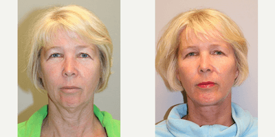 Case 9212 - Woman treated with Chin Implant
