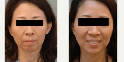 Case 9217 - 45-54 year old woman treated with Chin Implant