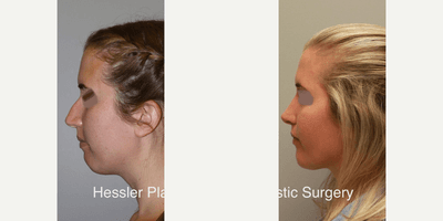 Case 9219 - Woman treated with Chin Implant