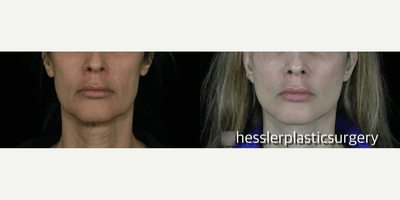Case 9318 - Woman treated with Neck Lift