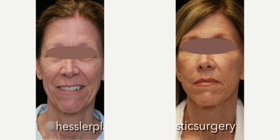 Case 9322 - Woman treated with Neck Lift