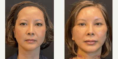 Case 9451 - 45-54 year old woman treated with Facelift, Eyelid Surgery, Neck Lift, Buccal Fat Removal, Brow Lift