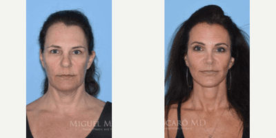 Case 9452 - Woman treated with Brow Lift