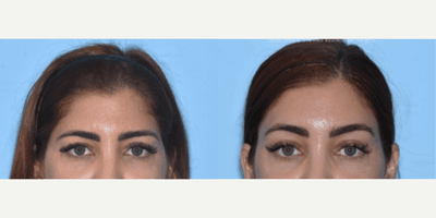 Case 9453 - Woman treated with Brow Lift