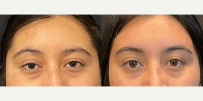 Case 9454 - Woman treated with Brow Lift