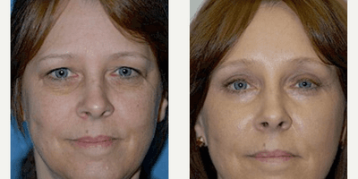 Case 9457 - Woman treated with Brow Lift
