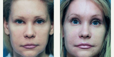 Case 9459 - Woman treated with Brow Lift