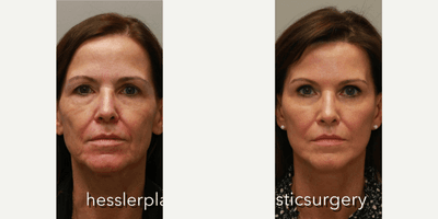 Case 9476 - Woman treated with Brow Lift