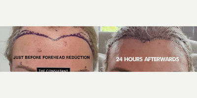 Case 9480 - Woman treated with Brow Lift