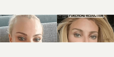 Case 9481 - Woman treated with Brow Lift