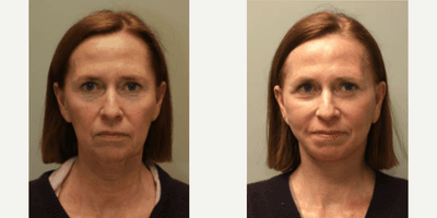 Case 9497 - Woman treated with Brow Lift