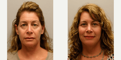 Case 9499 - Woman treated with Brow Lift