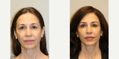 Case 9515 - Woman treated with Brow Lift