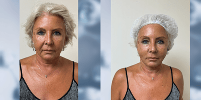Case 9571 - 65-74 year old woman treated with Nonsurgical Facelift, Thread Lift, Nonsurgical Neck Lift, Botox