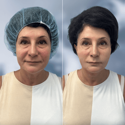 Case 9572 - 55-64 year old woman treated with Thread Lift, Nonsurgical Facelift, Nonsurgical Neck Lift