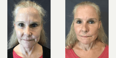 Case 9573 - Woman treated with Thread Lift