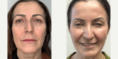 Case 9574 - Woman treated with Thread Lift