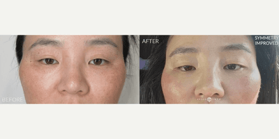 Case 9575 - Woman treated with Thread Lift