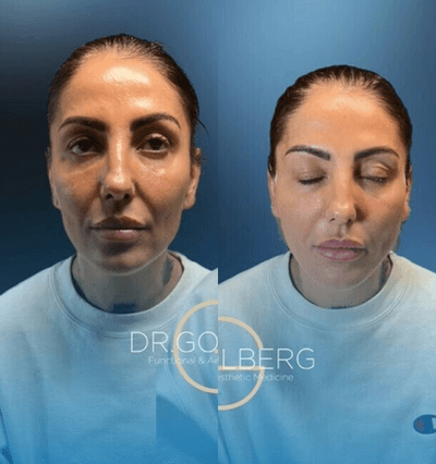 Case 9576 - Woman treated with Thread Lift