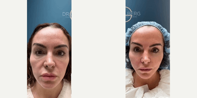 Case 9577 - Woman treated with Thread Lift