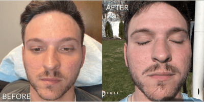 Case 9578 - Man treated with Bellafill, CO2 Laser, PRP Injections, Thread Lift