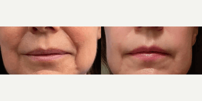 Case 9579 - Woman treated with Thread Lift