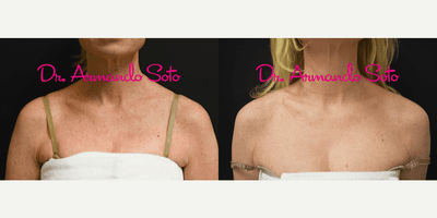 Case 9762 - Woman treated with Halo Laser