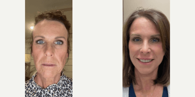 Case 9789 - 55-64 year old woman treated with Laser Resurfacing