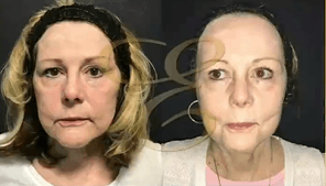 Case 9790 - Woman treated with Laser Resurfacing