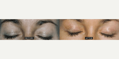 Case 9791 - Woman treated with Laser Resurfacing